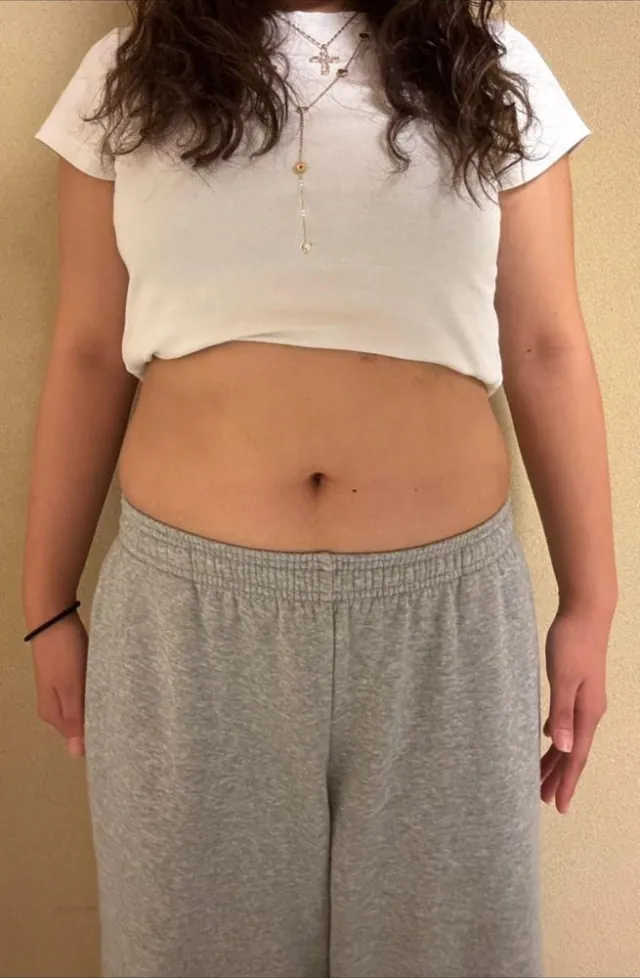 20代女性 ／ 4ヶ月 BEFORE 正面